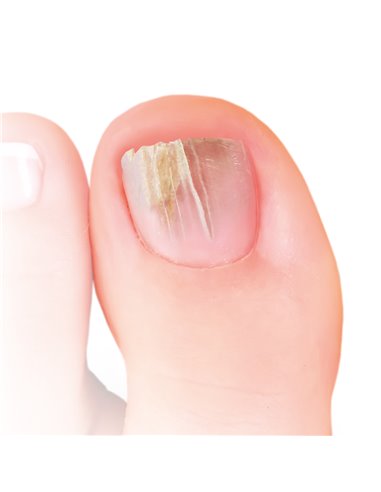 Nailner Pincel 2 En 1 Antihongos 5 Mililitros Nailner